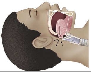 Schéma des voies respiratoires obstruées