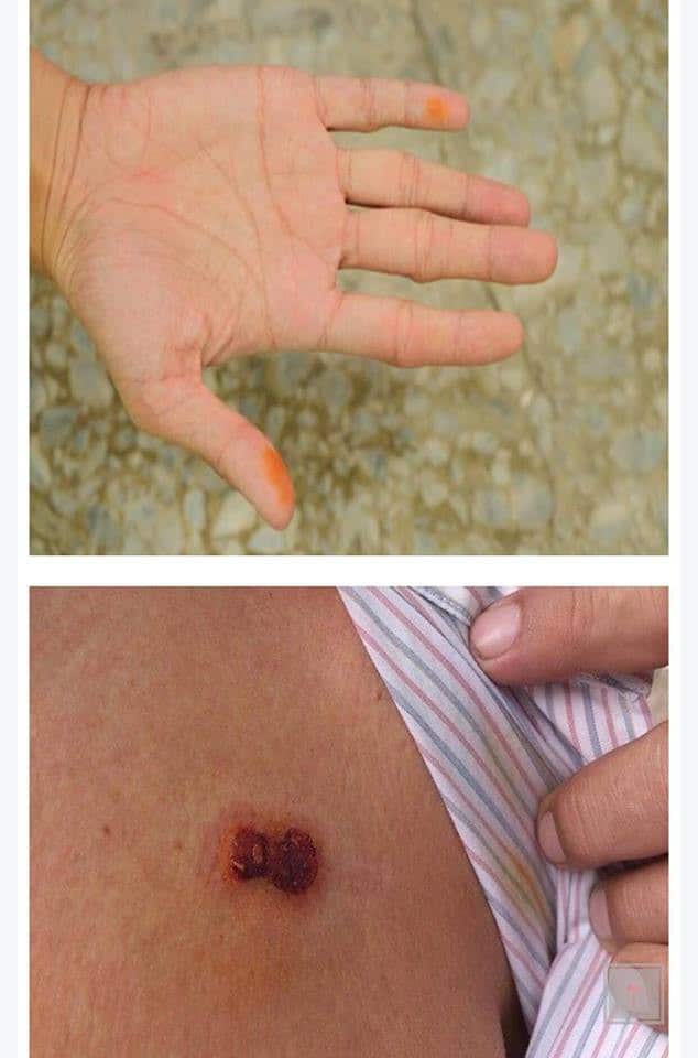 Soins d'urgence pour brûlure chimique