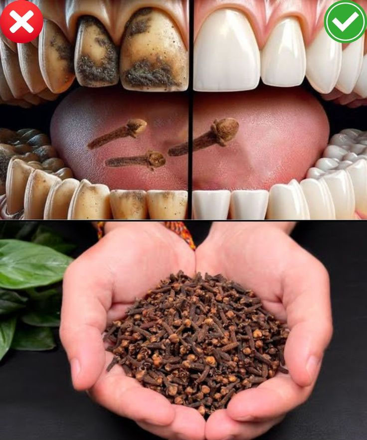 Clous de girofle, un remède naturel pour les dents
