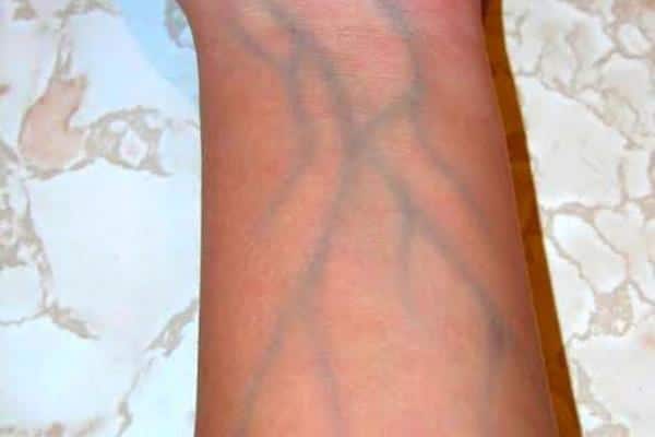 Réseau veineux visible sur un avant-bras
