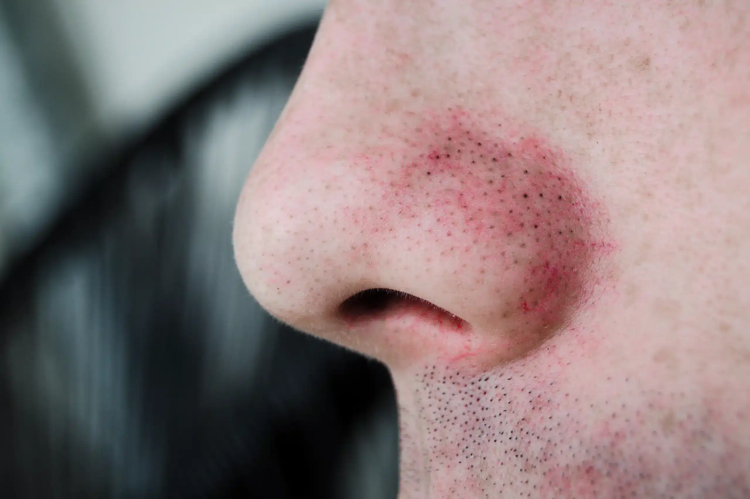Visage avec points noirs