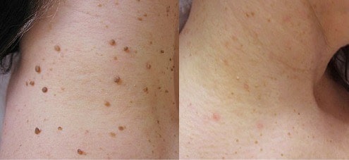 comparaison avant/après traitement d'un acrochordon